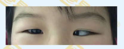 什么是先天性?xún)?nèi)斜視？