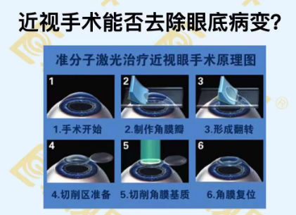 近視手術能否去除眼底病變？