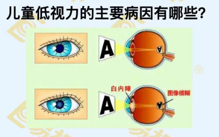 兒童低視力主要病因有哪些？
