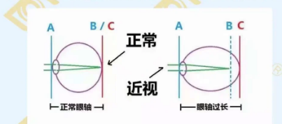哪個年齡近視度數(shù)最容易增長？