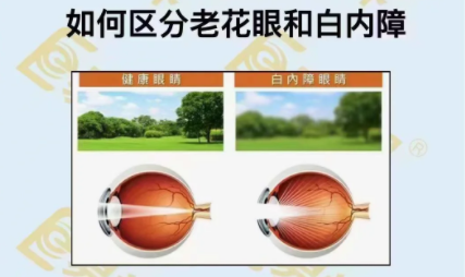 如何區(qū)分老花眼和白內(nèi)障？