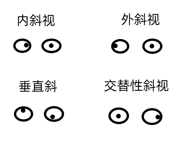 斜視早期的癥狀有哪些？